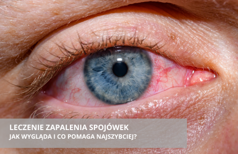 Jak wygląda leczenie zapalenia spojówek i co pomaga najszybciej?