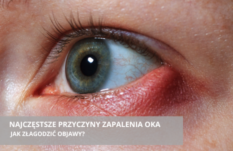 Jakie są najczęstsze przyczyny zapalenia oka i jak złagodzić jego objawy?